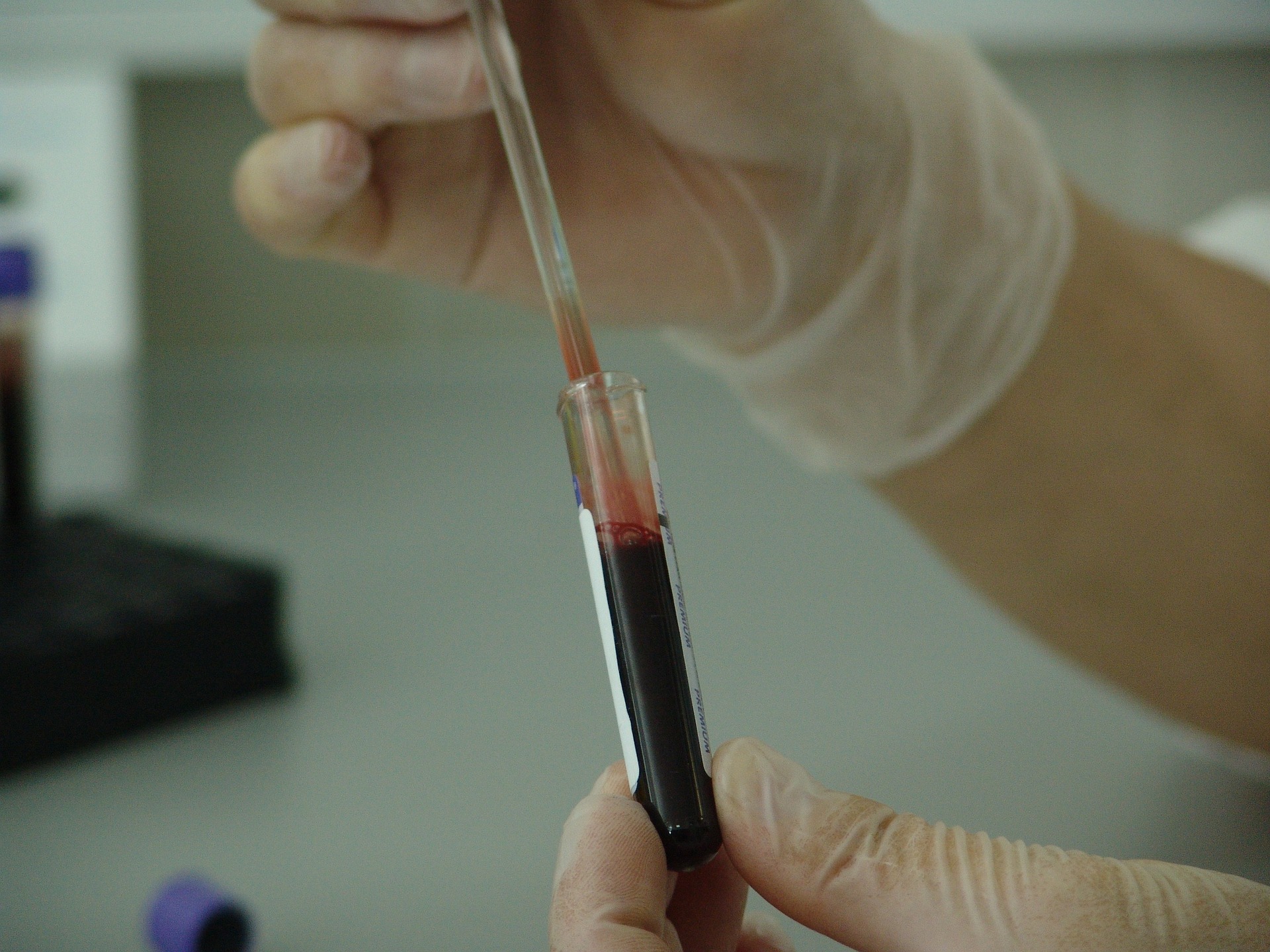 Blut Phiole Analyse Labor AIDS